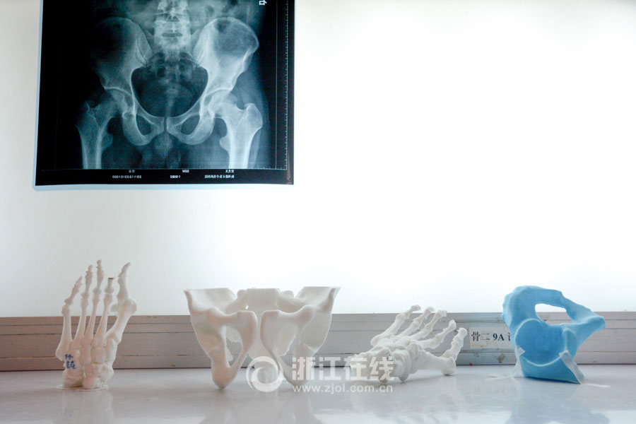3D printing technology applied to rebuilding skeletons 
